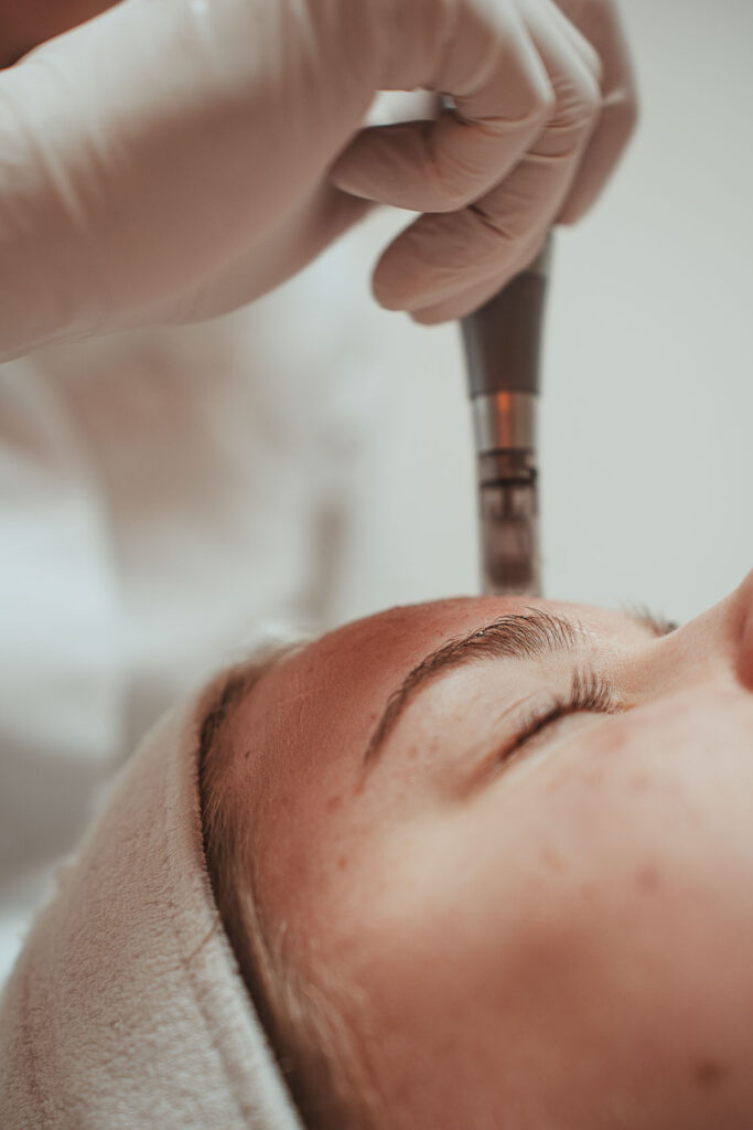 Dermapen behandeling Hoeksche Waard