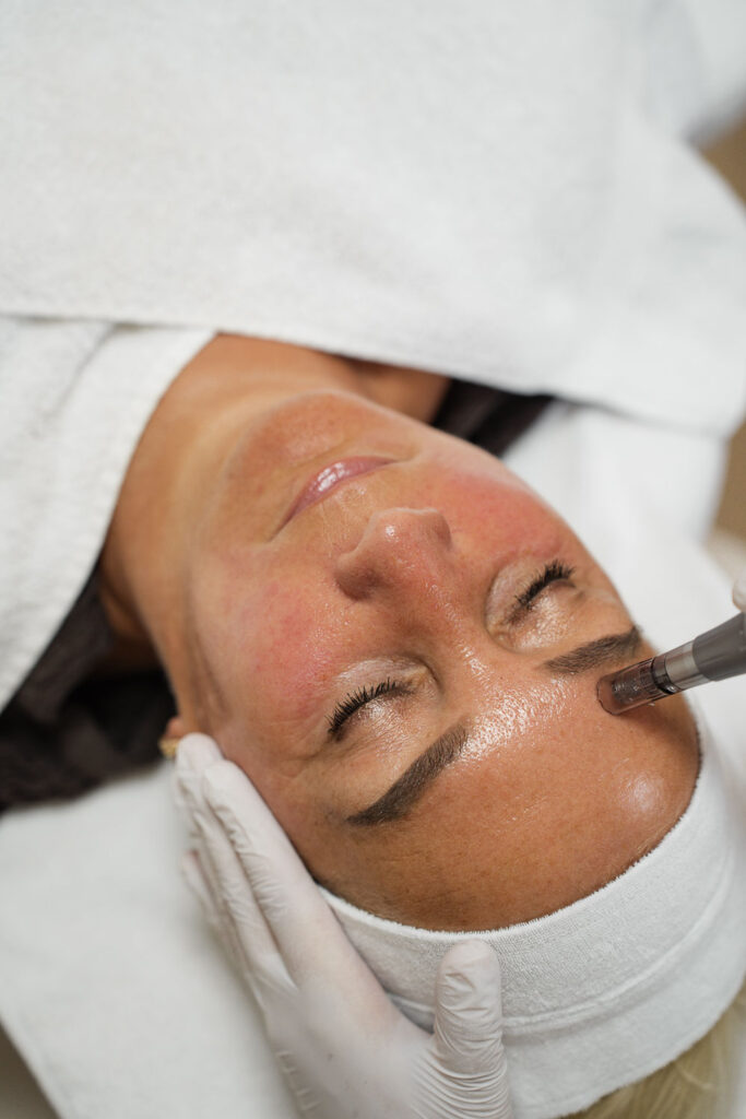 Microneedling voor acne littekens