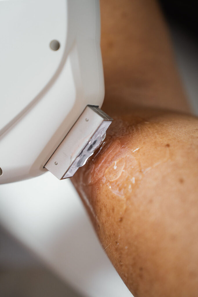 IPL huidtherapie behandeling bij VeraLune