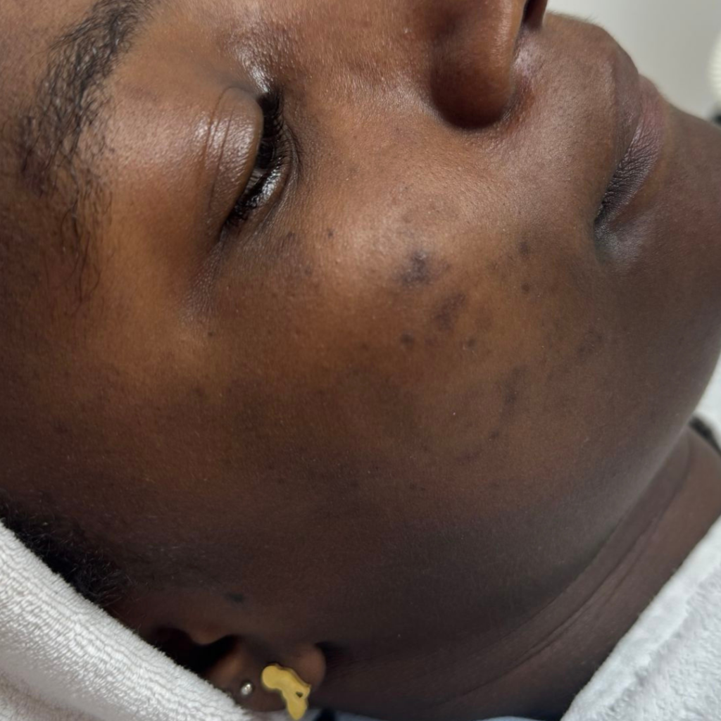 Microneedling voor acne littekens