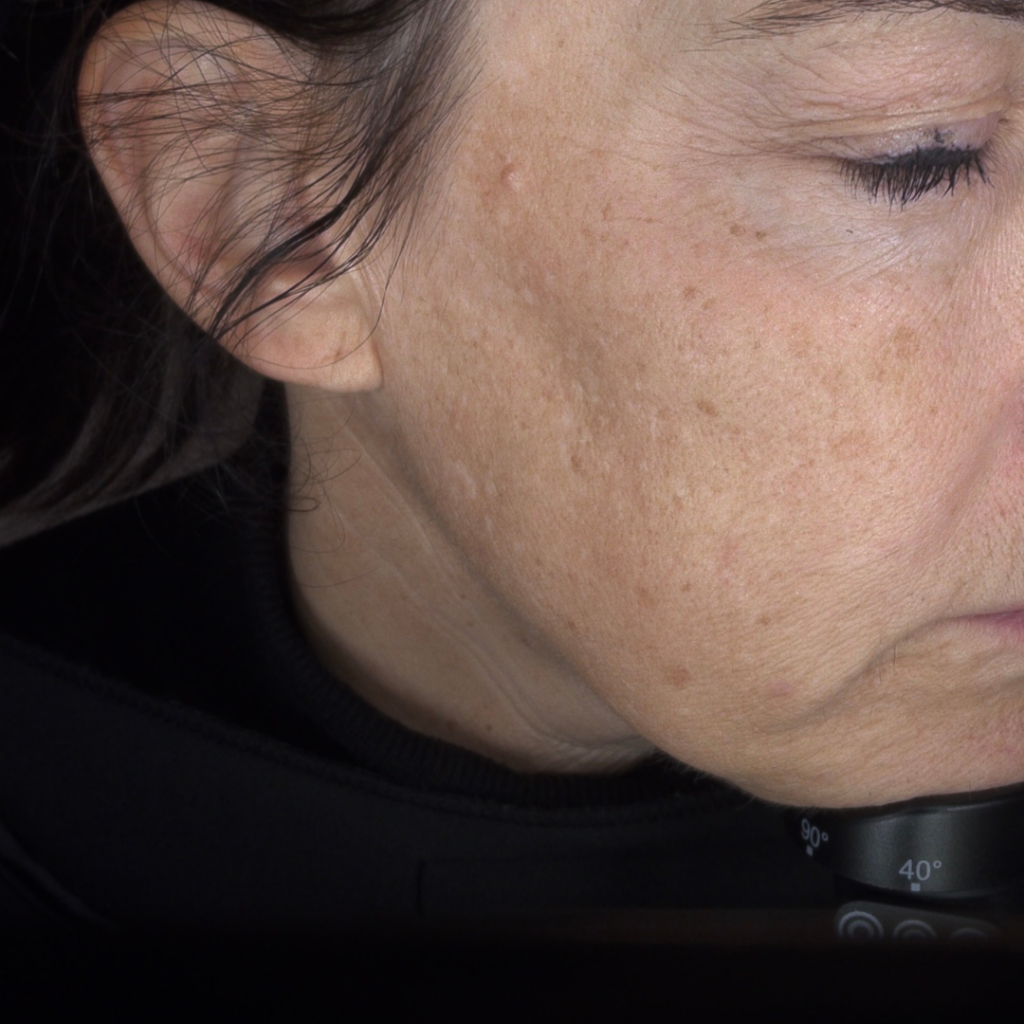 IPL gezichtsbehandeling huidverbetering