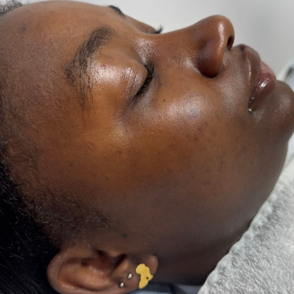 Microneedling voor acne littekens