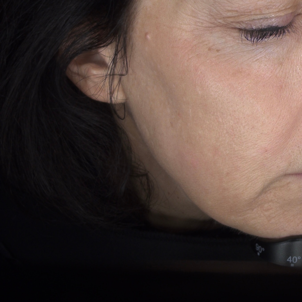 IPL gezichtsbehandeling huidverbetering