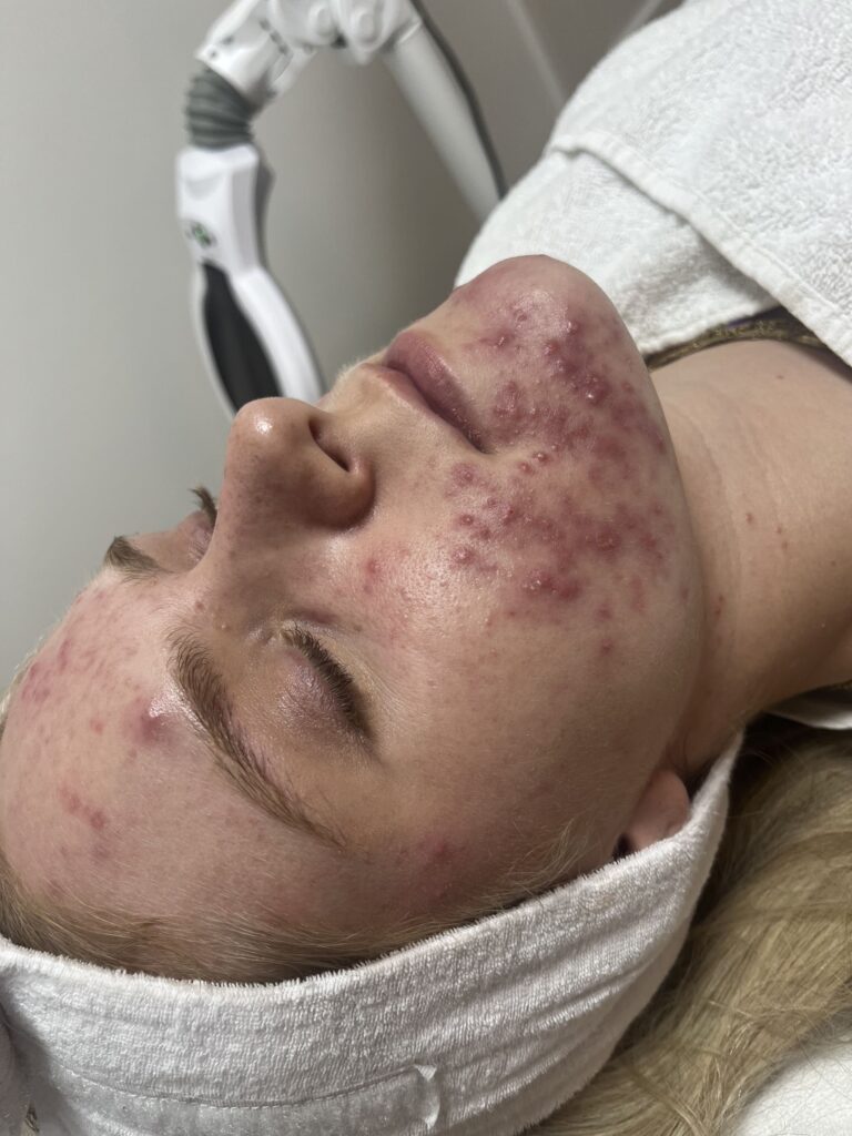 LED-therapie na acne